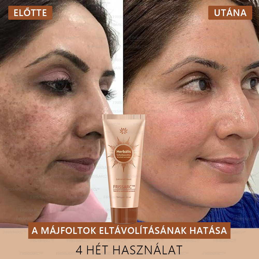 ✨ 𝐅𝐑𝐈𝐒𝐒𝐀𝐑𝐂™ Arcmaszk | Látható folthalványítás természetes összetevőkkel – szeplőkre, pigmentfoltokra, napkárosodásra