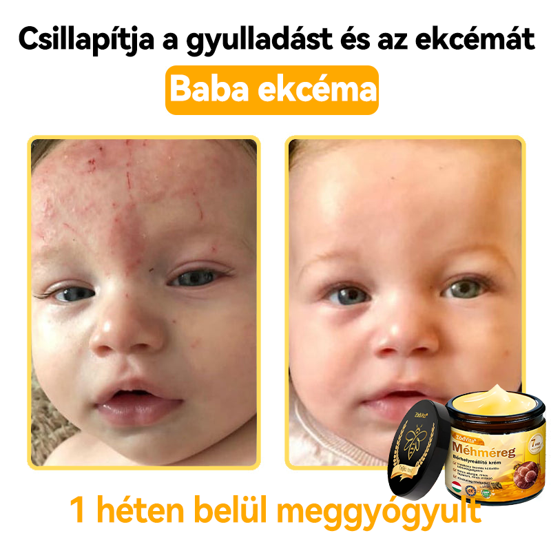 🔥🔥 Bőrgyógyász ajánlása ✨ ZödVita® Méhméreg Bőr Helyreállító Krém – Időskori purpura, ráncok és a bőr állapotának látványos javítása 💜 Magyar fejlesztés, magyarországi gyártás és szállítás