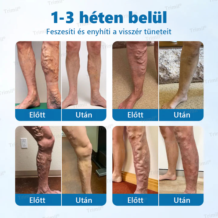 🔥🔥Trimil® VeinGuard Gyógynövényes Spray-✅ Klinikailag bizonyított, hogy mindössze 7 nap alatt megszünteti a visszereket!