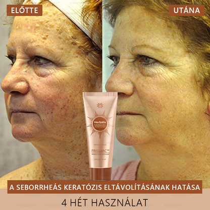 🎁𝐅𝐑𝐈𝐒𝐒𝐀𝐑𝐂™ Arcmaszk | Látható folthalványítás természetes összetevőkkel – szeplőkre, pigmentfoltokra, napkárosodásra🎁