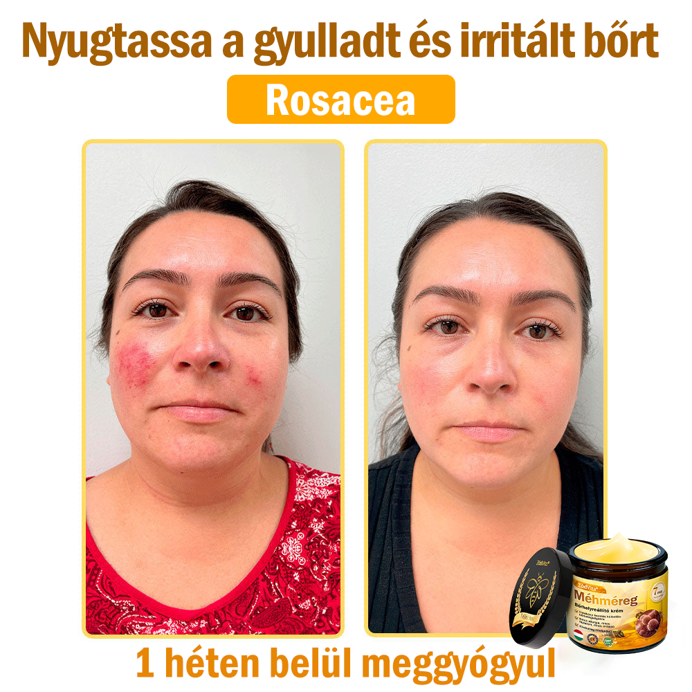 🔥🔥 Bőrgyógyász ajánlása ✨ ZödVita® Méhméreg Bőr Helyreállító Krém – Időskori purpura, ráncok és a bőr állapotának látványos javítása 💜 Magyar fejlesztés, magyarországi gyártás és szállítás