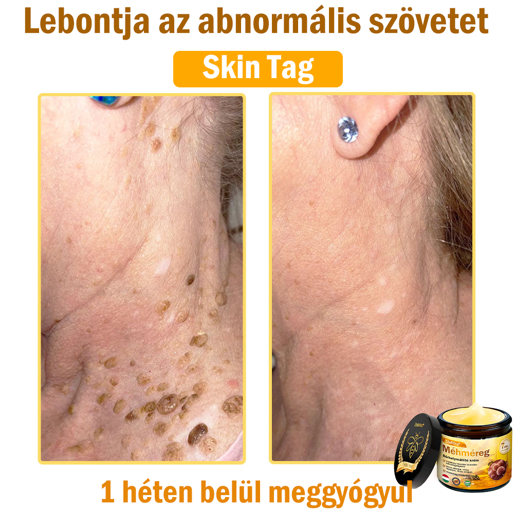 ✨✨Bőrgyógyász ajánlása ✨ ZödVita® Méhméreg Bőr Helyreállító Krém – Időskori purpura, ráncok és a bőr állapotának látványos javítása 💜 Magyar fejlesztés, magyarországi gyártás és szállítás