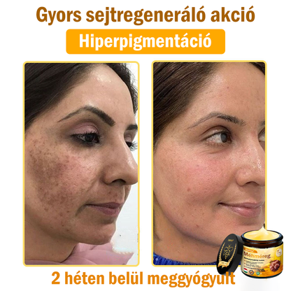 ✨✨Bőrgyógyász ajánlása ✨ ZödVita® Méhméreg Bőr Helyreállító Krém – Időskori purpura, ráncok és a bőr állapotának látványos javítása 💜 Magyar fejlesztés, magyarországi gyártás és szállítás